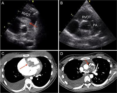 Successful management of a rare case of juvenile giant right ventricular myxoma